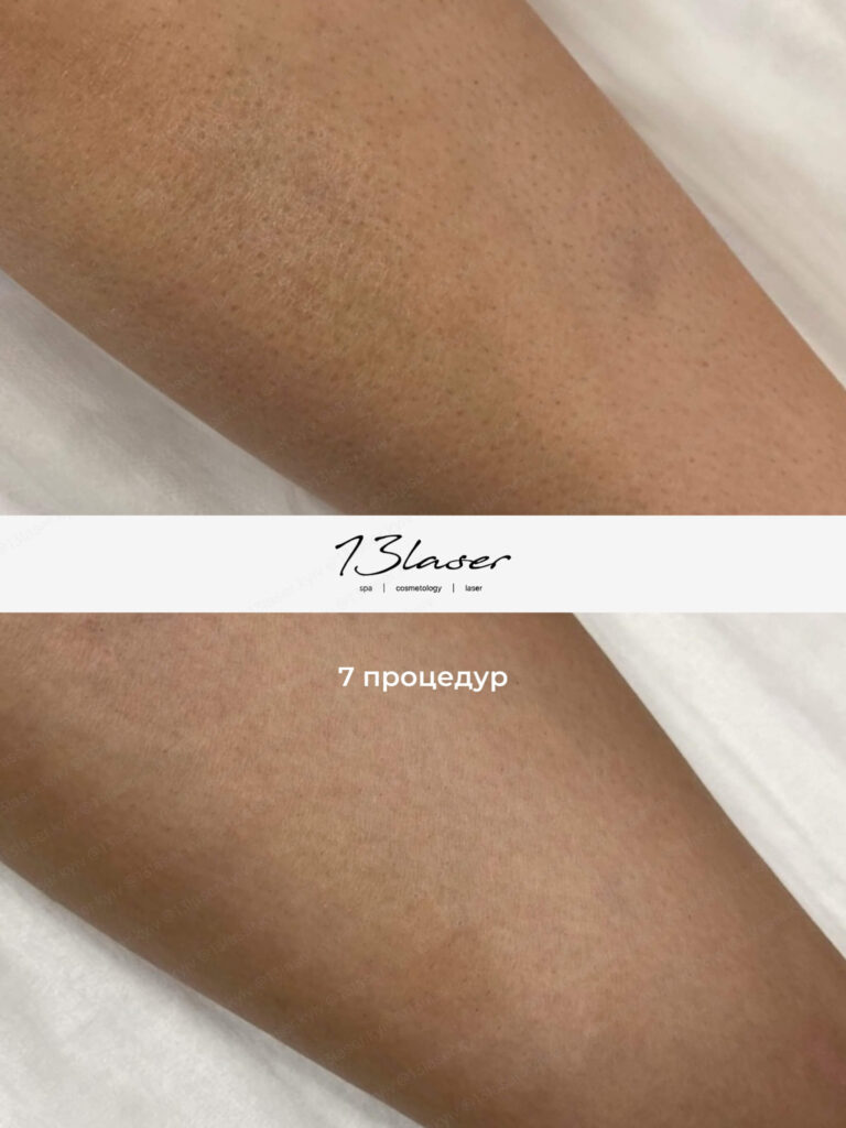 Лазерна епіляція гомілок