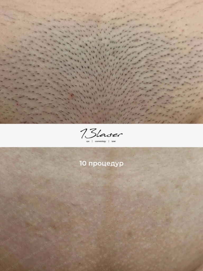 Лазерна епіляція глибокого бікіні