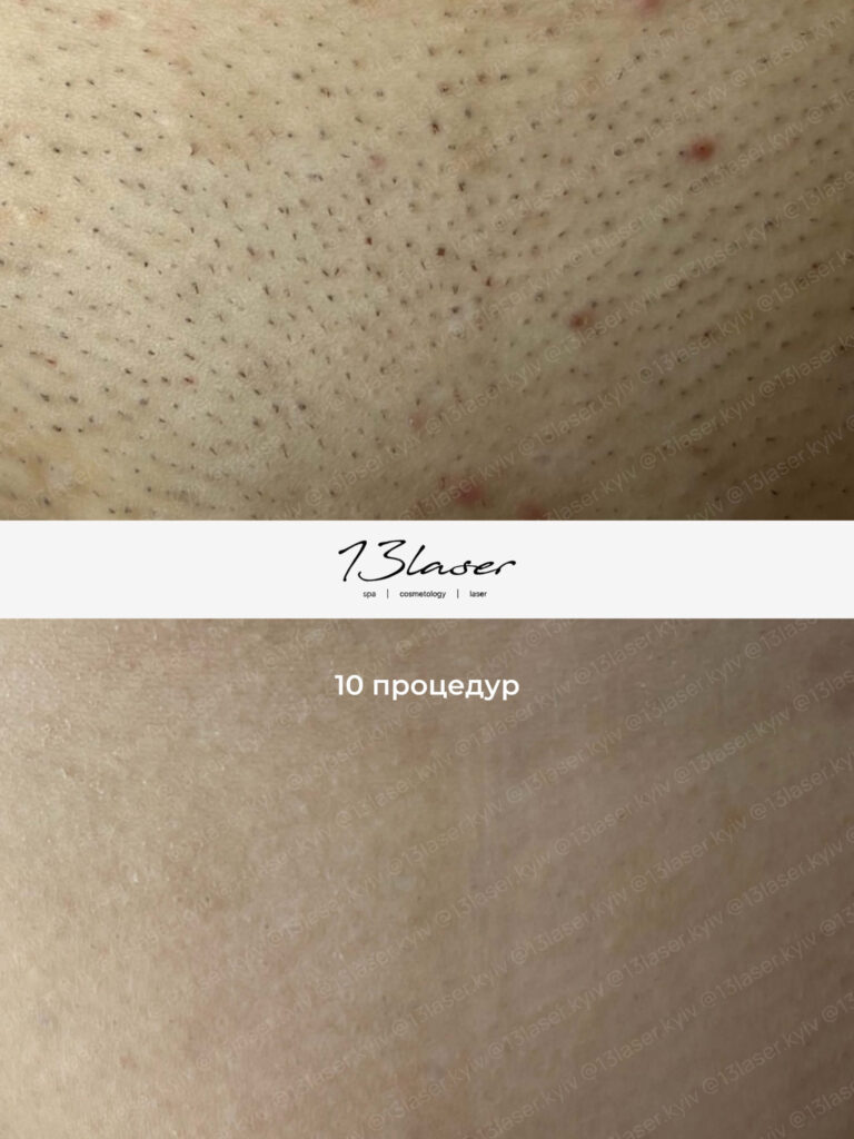Лазерна епіляція глибоке бікіні